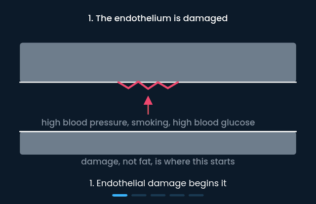 Atheroma forming in an artery, from endothelial damage to a narrowed lumen